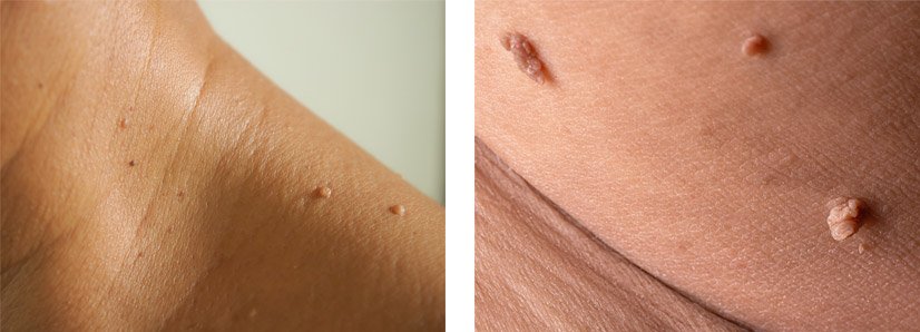 skin-tags
